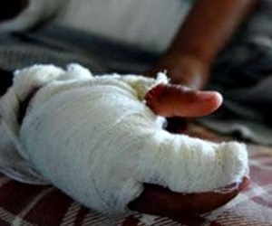 Reducción de lesionados con pólvora en el Cauca en año nuevo